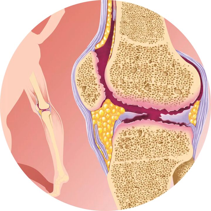 Hondroten - podpira gibljivost sklepov